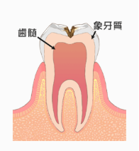 Ｃ２：象牙質の虫歯