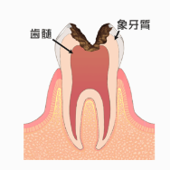 Ｃ３：神経に達した虫歯