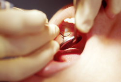 シーラントによる虫歯予防